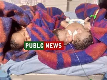 WOMAN GIVE BIRTH TO TWINS WITH ONE BABY HAVING TWO HEADS IN MAUA MERU COUNTY jpg Woman Give Birth To A Baby With Two Heads In Meru